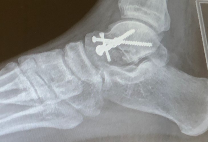 An x-ray of Liam Olson's right ankle after surgery showing metal screws. 