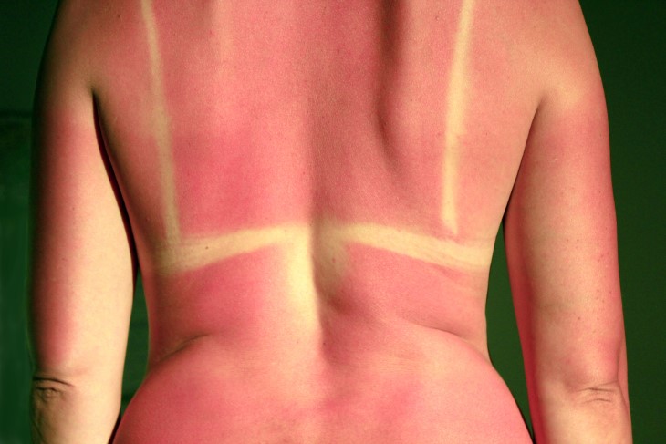 A close-up photo of a woman's back which is badly sunburnt. 