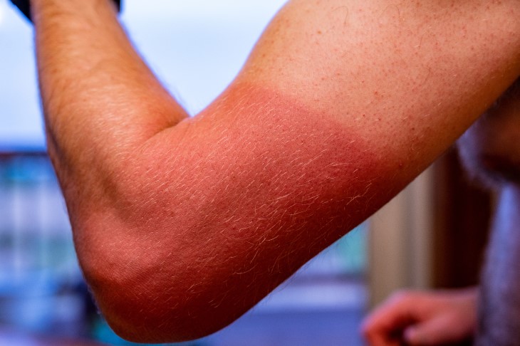 A close-up of a man's arm which is badly sunburnt. 