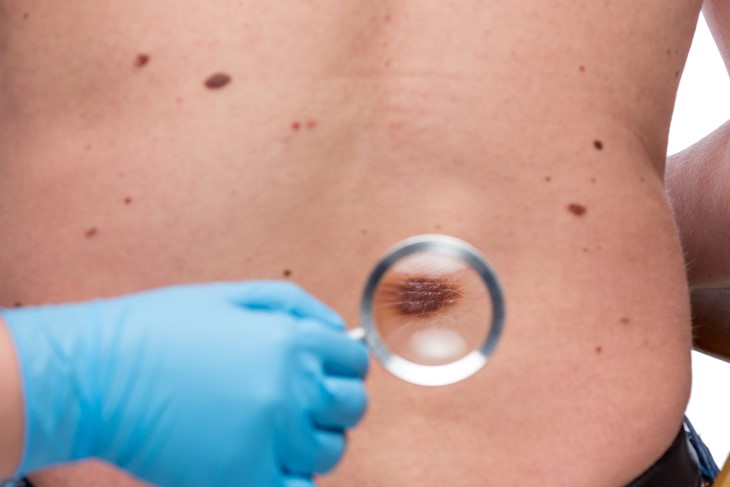 A close-up photo of a doctor examining a mole on a man's back with a magnifying glass. 